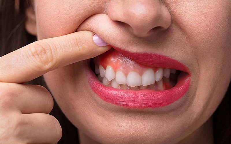 Nướu răng bị sưng: Nguyên nhân và cách điều trị