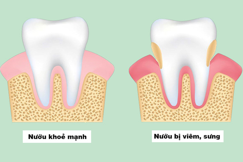 Răng bị viêm nướu răng có mủ có nguy hiểm không?
