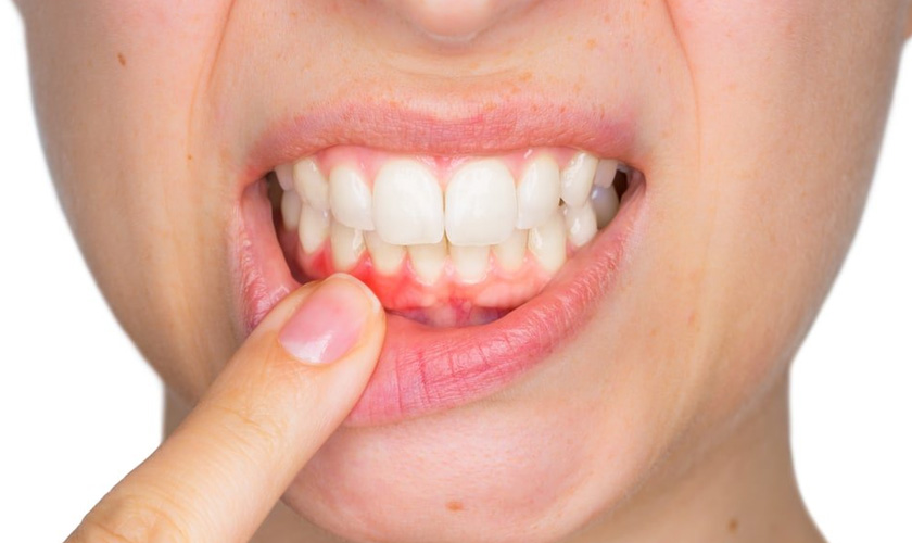 Tổng quát về bệnh nha chu