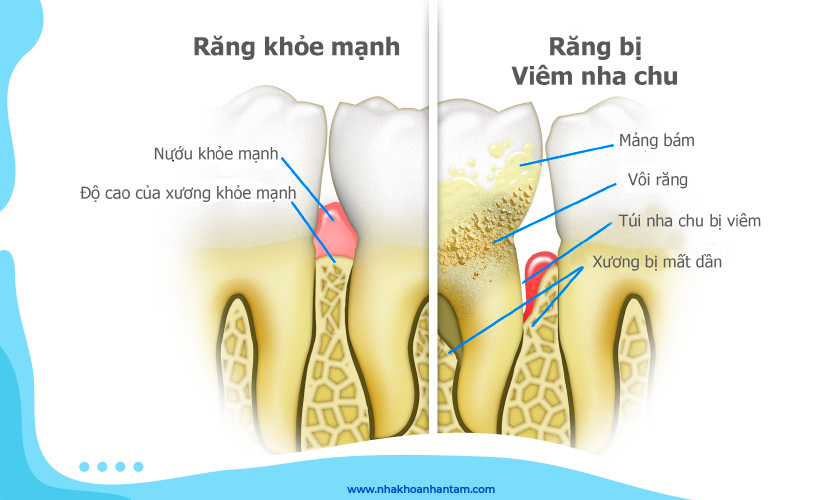 Răng bị viêm nha chu