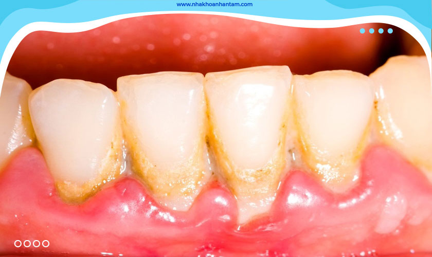 Cao răng là nguyên nhân chính gây bệnh nha chu