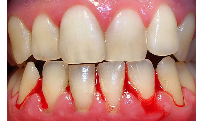 Viêm nha chu gây chảy máu chân răng