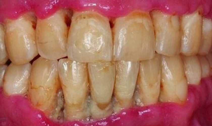 Bệnh nha chu có thể là nguyên nhân dẫn đến viêm nướu răng có mủ