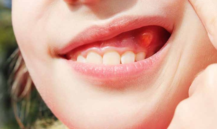 Viêm nướu răng có mủ gây ảnh hưởng nghiêm trọng đến sức khỏe răng miệng