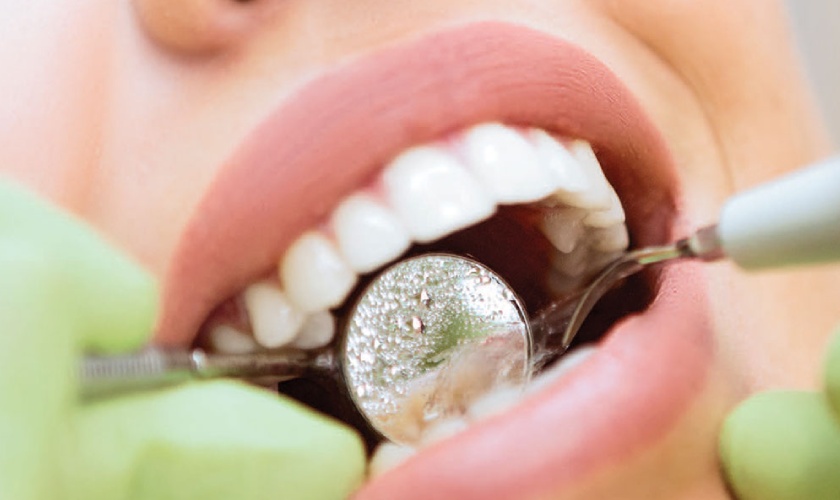 Cạo vôi răng là một trong những cách điều trị viêm nướu răng có mủ