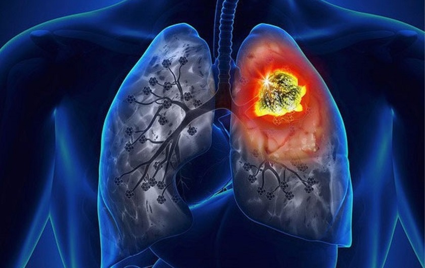 Viêm nướu cũng có thể dẫn đến bệnh lý viêm phổi