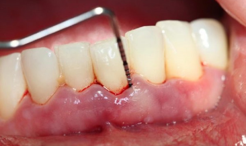 Phương pháp nạo túi nha chu loại bỏ ổ viêm nhiễm
