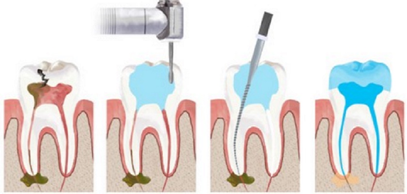 Lấy tủy răng là biện pháp thường được chỉ định khi tủy viêm nhiễm nặng