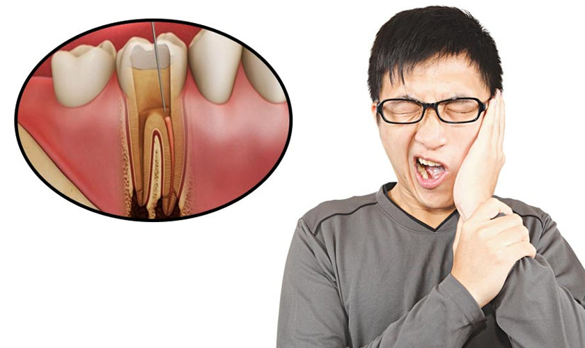Cách điều trị viêm tuỷ răng hiện nay là gì?