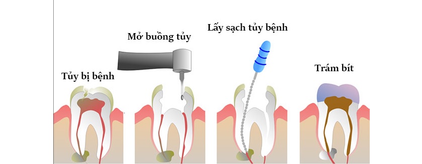 Điều trị viêm tuỷ răng mất bao lâu?