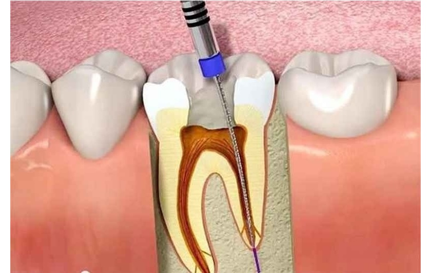 Điều trị viêm tuỷ răng