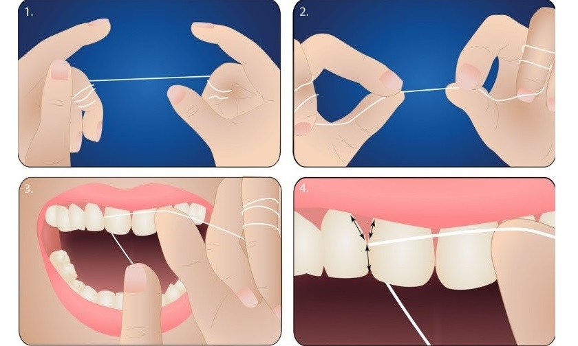 Vệ sinh răng miệng đúng cách để phòng ngừa viêm tuỷ răng