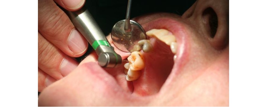 Quy trình điều trị tuỷ răng bạn cần biết!