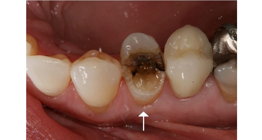 Chữa tuỷ răng không sạch gây ra nhiều biến chứng nguy hiểm cho sức khoẻ răng miệng