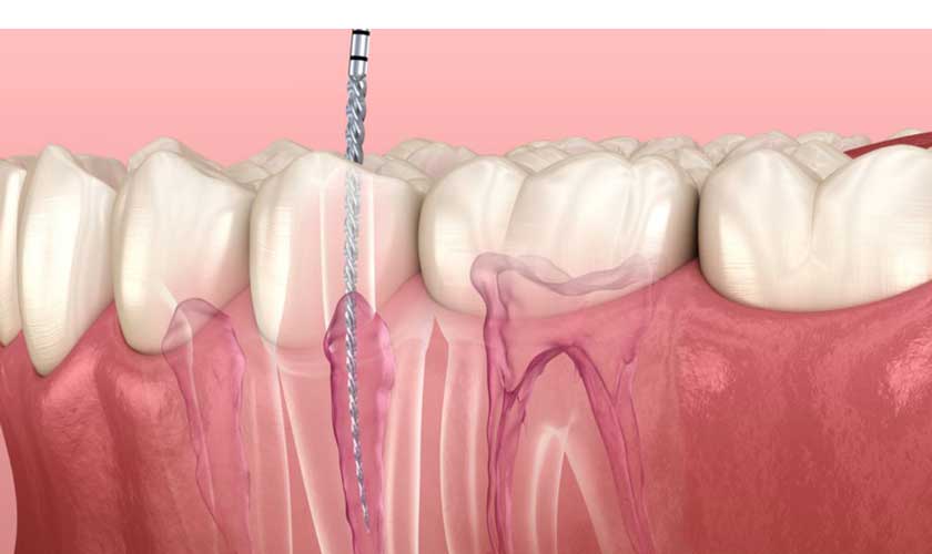 Điều trị tủy răng