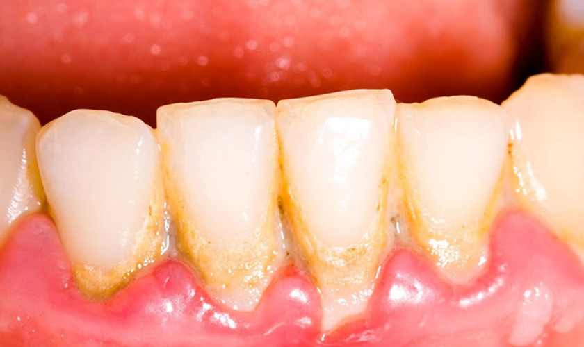 Vôi răng hình thành nhiều có thể gây bệnh viêm tủy răng