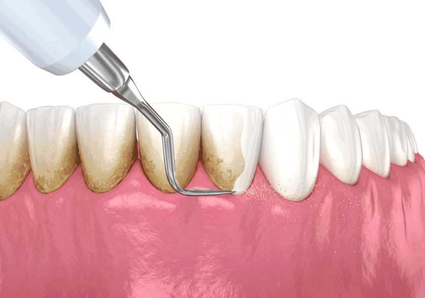 Trường hợp nào thì nên cạo vôi răng?