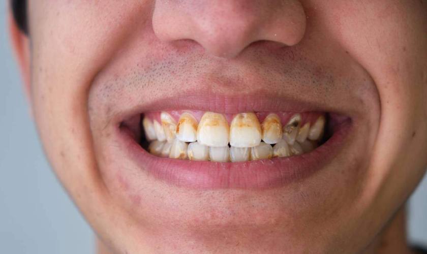 Vi khuẩn trong vôi răng phá hủy cấu trúc răng và hình thành lỗ sâu răng Vi khuẩn trong vôi răng phá hủy cấu trúc răng và hình thành lỗ sâu răng