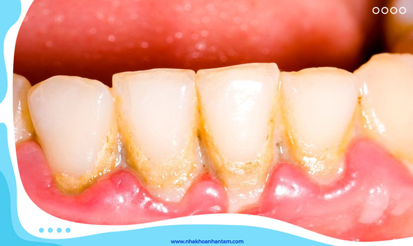 Chi phí cạo vôi răng còn tùy thuộc vào mức độ vôi nhiều hay ít