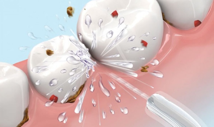 Nha khoa Nhân Tâm đang thực hiện cạo vôi răng bằng công nghệ sóng siêu âm hiện đại