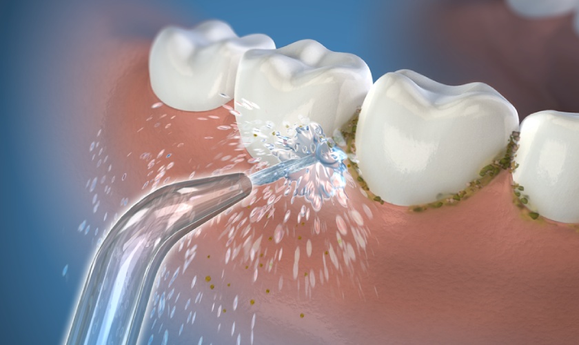 Nên cạo vôi răng 3-6 tháng/lần