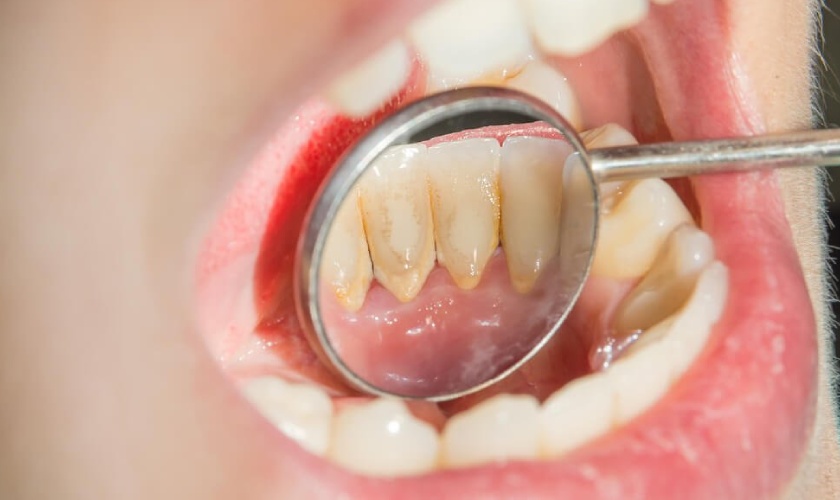 Cao răng bám khá cứng chắc nên không thể tự rơi ra