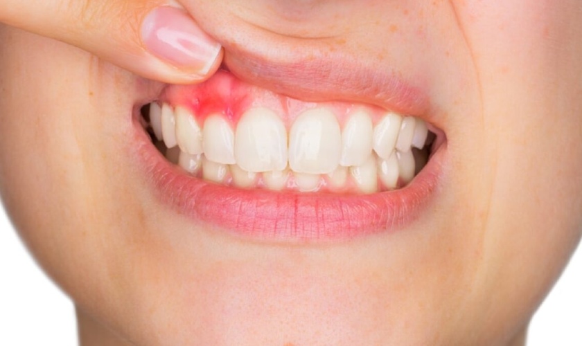 Vôi răng là nguyên nhân hàng đầu dẫn đến viêm nướu