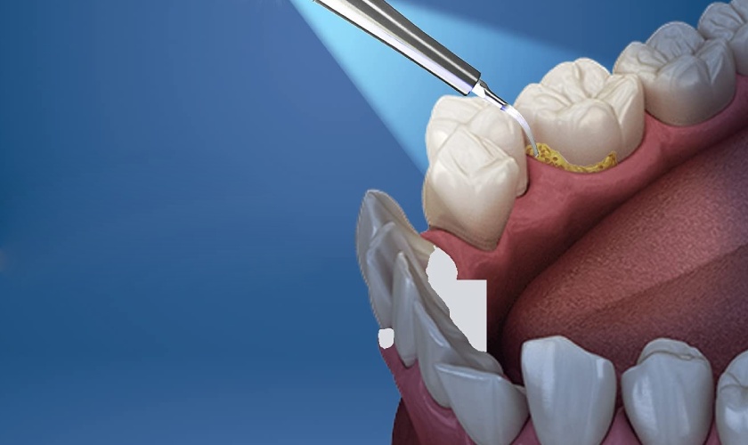 Cạo vôi răng có tác động đến cảnh giác của răng không?
