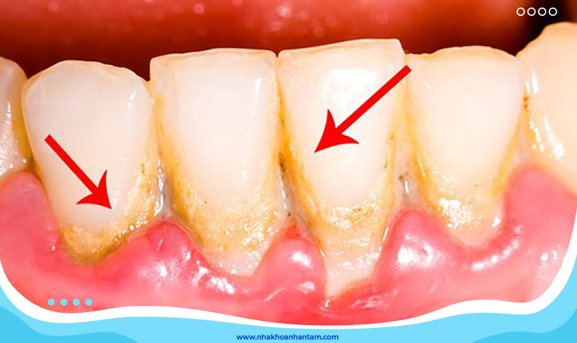 Cạo vôi răng có đau không còn tùy thuộc vào mức độ vôi nhiều hay ít