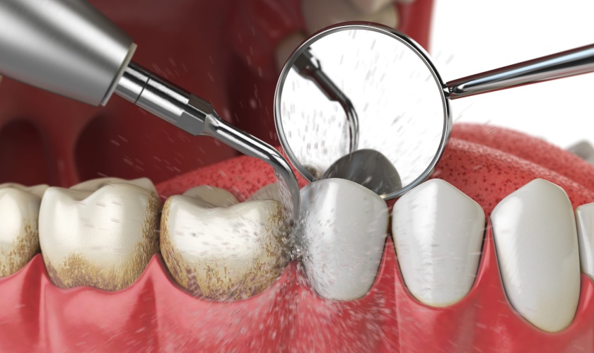  Lấy cao răng giúp răng trở nên trắng, sạch và phòng ngừa được bệnh viêm nhiễm răng lợi 