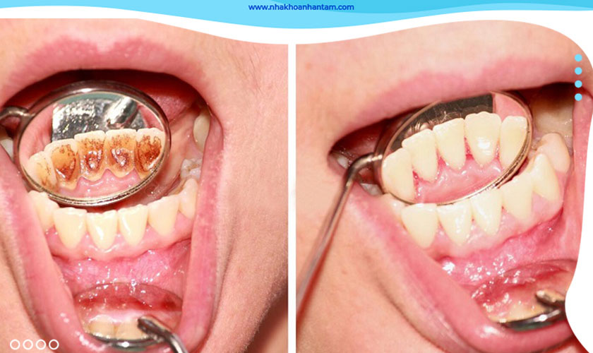 Cạo vôi răng không hề đau như bạn nghĩ