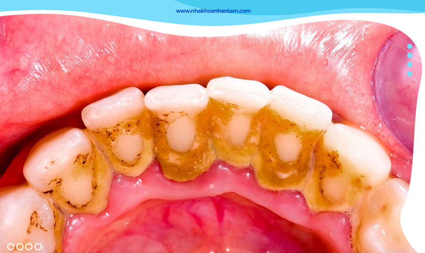 Vôi răng gây nguy hại cho sức khỏe răng miệng Vôi răng gây nguy hại cho sức khỏe răng miệng