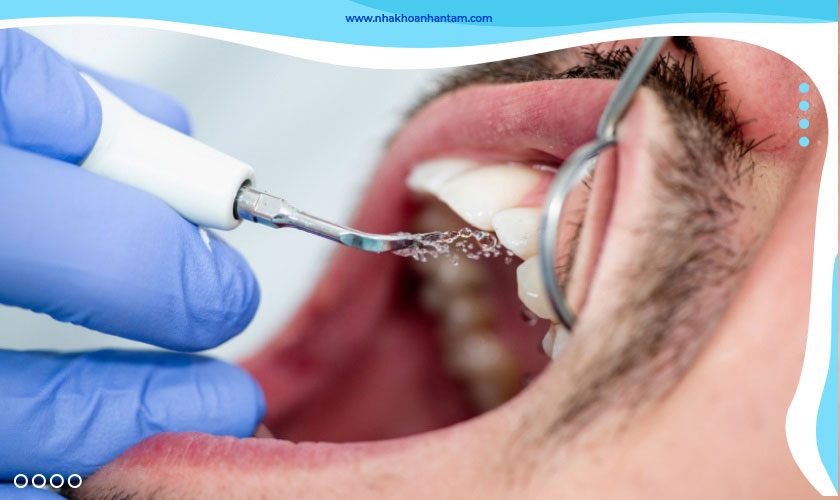 Cạo vôi răng bằng sóng siêu âm giúp lấy vôi nhẹ nhàng mà không gây đau buốt Cạo vôi răng bằng sóng siêu âm giúp lấy vôi nhẹ nhàng mà không gây đau buốt
