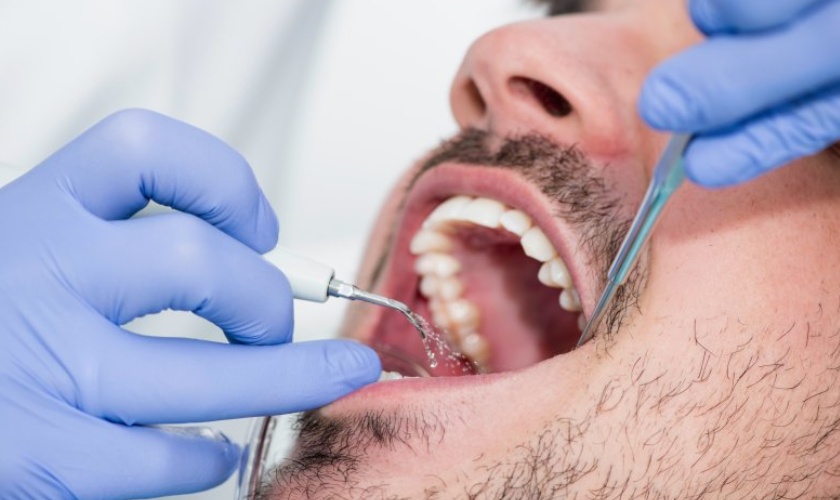 Cạo vôi răng mất bao lâu là câu hỏi được nhiều khách hàng quan tâm