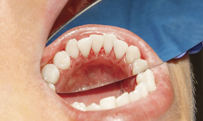 Cạo vôi răng giúp bảo vệ sức khỏe răng miệng được tốt hơn