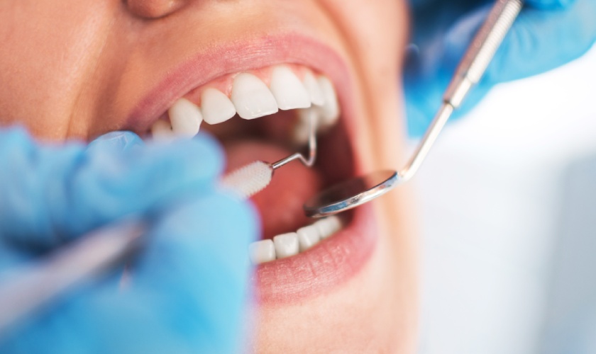 Cạo vôi răng mất thời gian bao lâu?