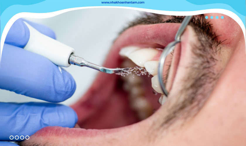 Cạo vôi răng ở đâu tốt và uy tín hiện nay?