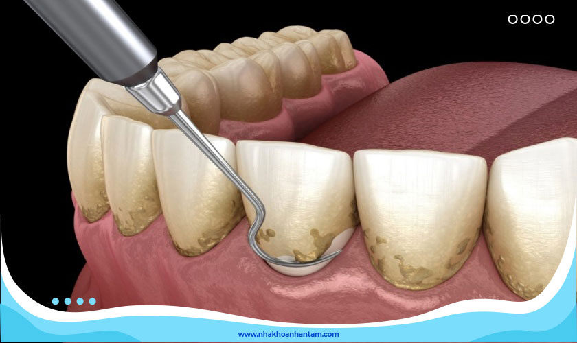 Chi phí cạo vôi răng có đắt lắm không?