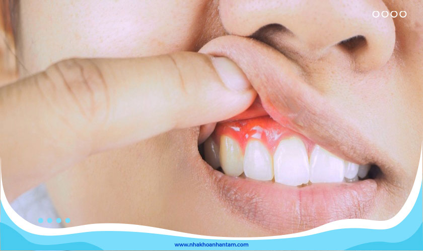 Vôi răng là nguyên nhân hàng đầu gây nên các bệnh lý răng miệng