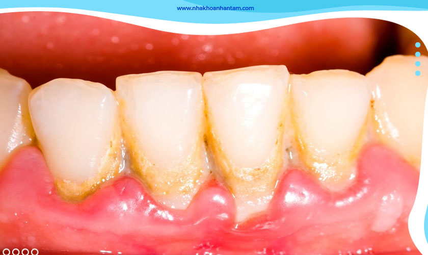 Chi phí cạo vôi răng còn tùy thuộc vào mức độ vôi răng nhiều hay ít