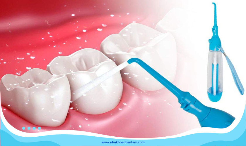 Có nên cạo vôi răng không? Chi phí bao nhiêu?