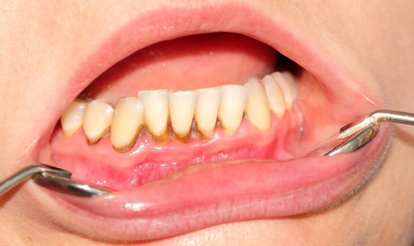 Vôi răng là nguyên nhân hàng đầu gây nên các bệnh lý răng miệng nguy hiểm