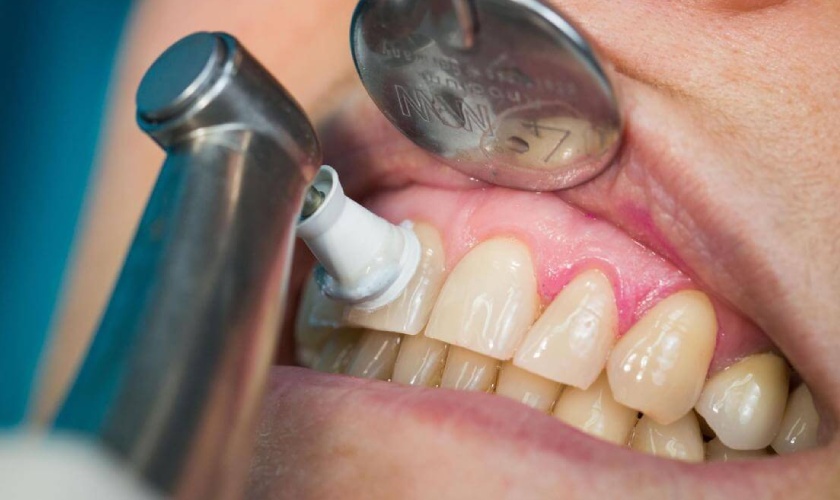 Giá cạo vôi răng còn tùy thuộc vào rất nhiều yếu tố