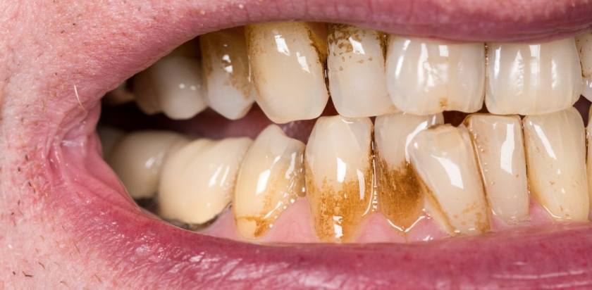 Vôi răng là nguyên nhân hàng đầu gây ra các bệnh lý răng miệng Vôi răng là nguyên nhân hàng đầu gây ra các bệnh lý răng miệng