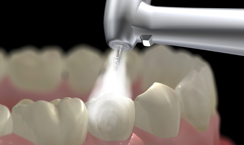 Tại sao máy cạo vôi răng nha khoa có thể gây hại cho răng của bạn