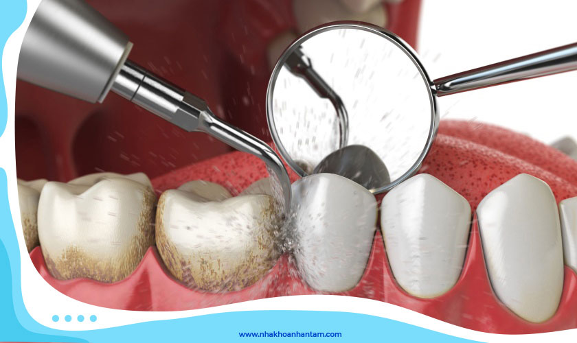 Tại sao nên cạo vôi răng định kỳ?