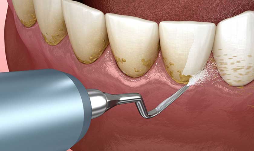 Cạo vôi răng siêu âm giúp rút ngắn thời gian thực hiện so với kỹ thuật cũ