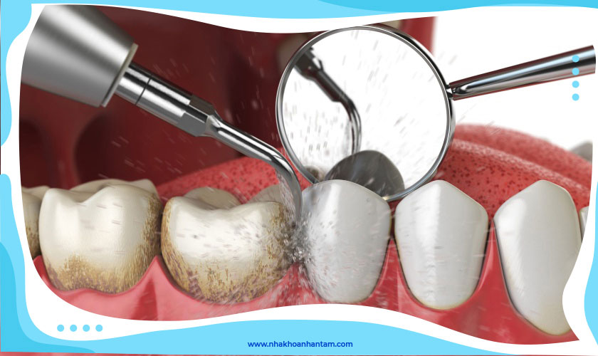 Máy cạo vôi răng siêu âm là công nghệ tiên tiến trong cạo vôi răng