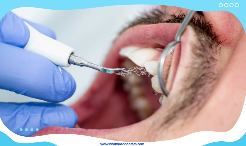 Máy cạo vôi răng siêu âm giúp lấy sạch vôi hoàn toàn không gây tổn thương nướu hay men răng