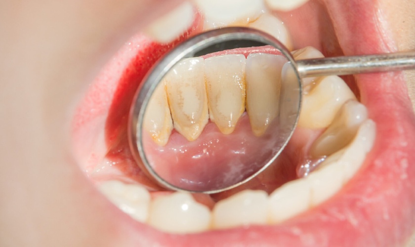 Vôi răng có nguy hiểm không?